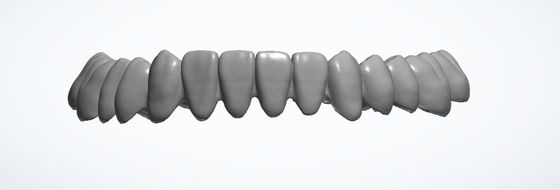 CAD CAM Dental Design Service AI Inlay Crown Upper Implant Crown
