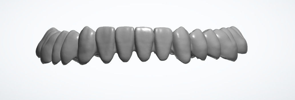 CAD CAM Dental Design Service AI Inlay Crown Upper Implant Crown